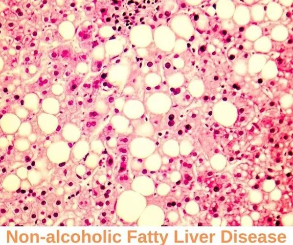 Non-Alcoholic Fatty Liver Disease (NAFLD)