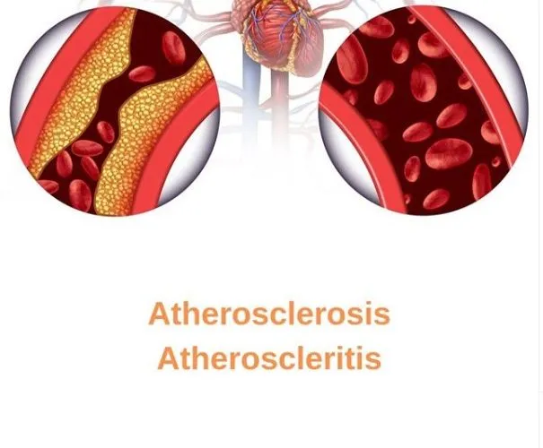 Atherosclerosis or Atheroscleritis