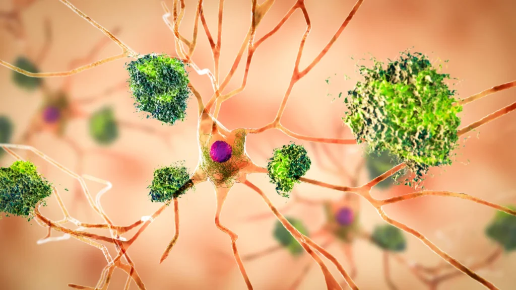 Altered cholesterol metabolism in the brain may have a role in Alzheimer’s.