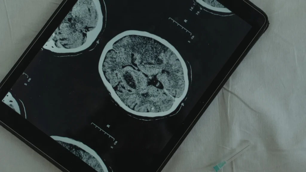 Altered Cholesterol Metabolism in the Brain and Alzheimer’s: The Metabolic Link