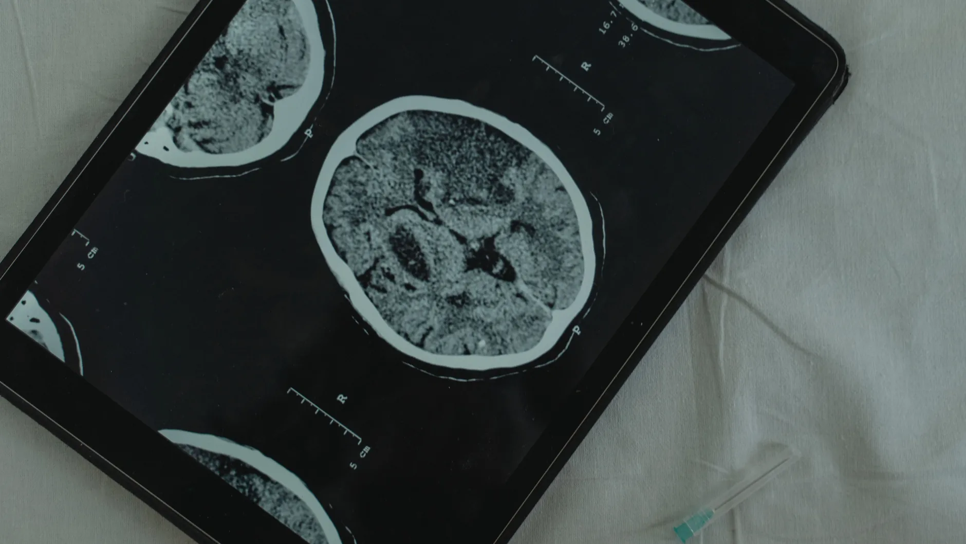 Altered Cholesterol Metabolism in the Brain and Alzheimer’s: The Metabolic Link